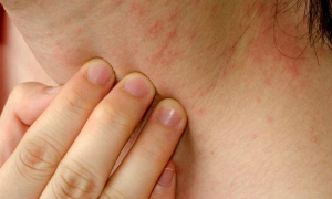 A expectativa é que o fitoterápico desenvolvido auxilie no tratamento de lesões cutâneas (Foto: divulgação/Getty Images)